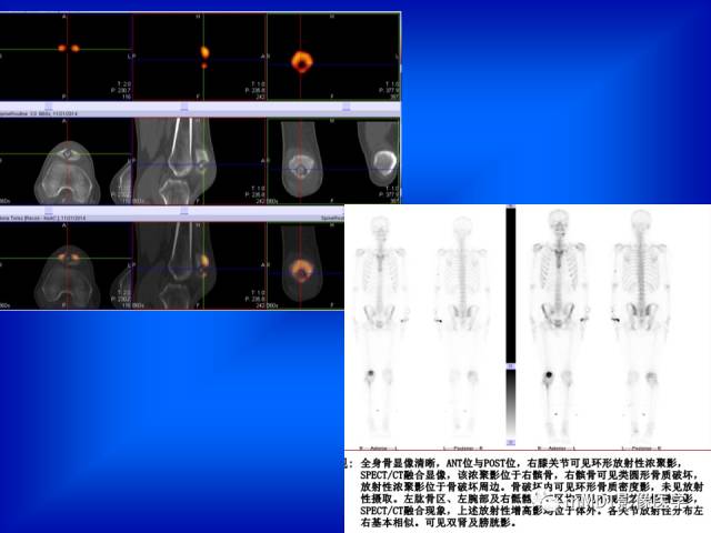 【PPT】骨骼系统核医学