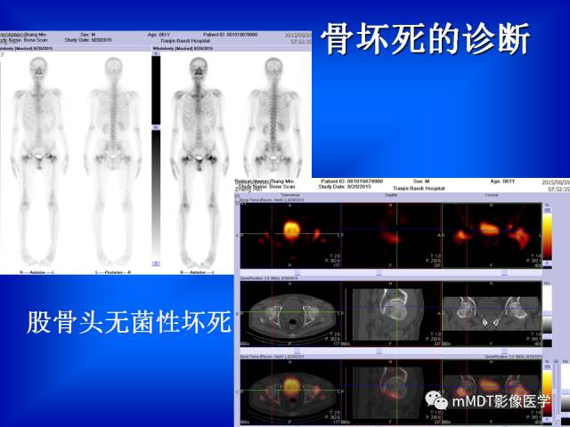 【PPT】骨骼系统核医学