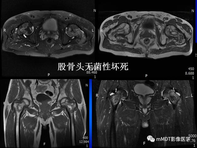 【PPT】骨骼系统核医学