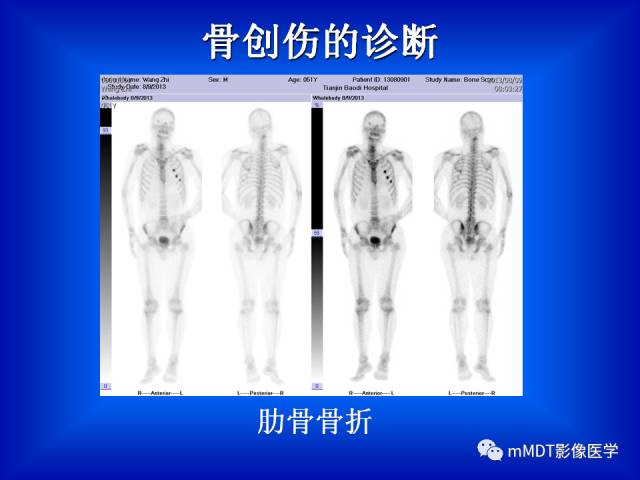 【PPT】骨骼系统核医学