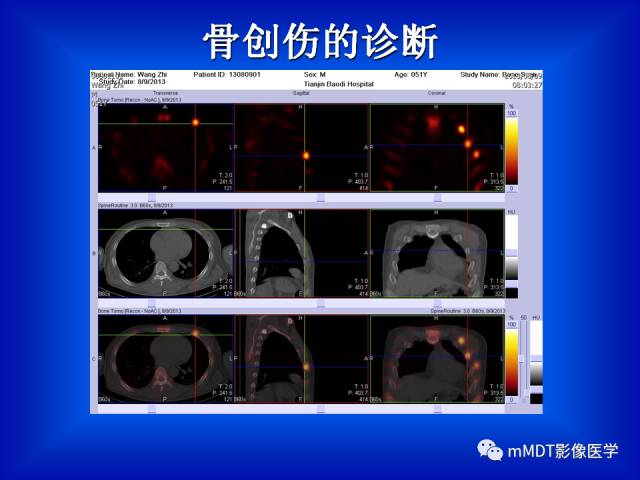 【PPT】骨骼系统核医学