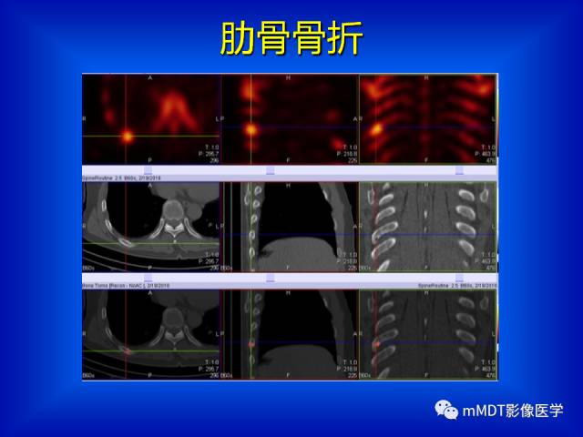 【PPT】骨骼系统核医学