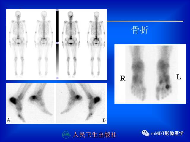 【PPT】骨骼系统核医学
