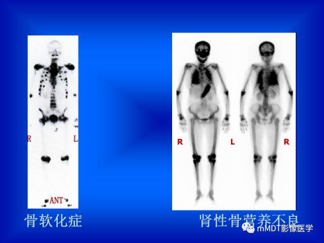 【PPT】骨骼系统核医学