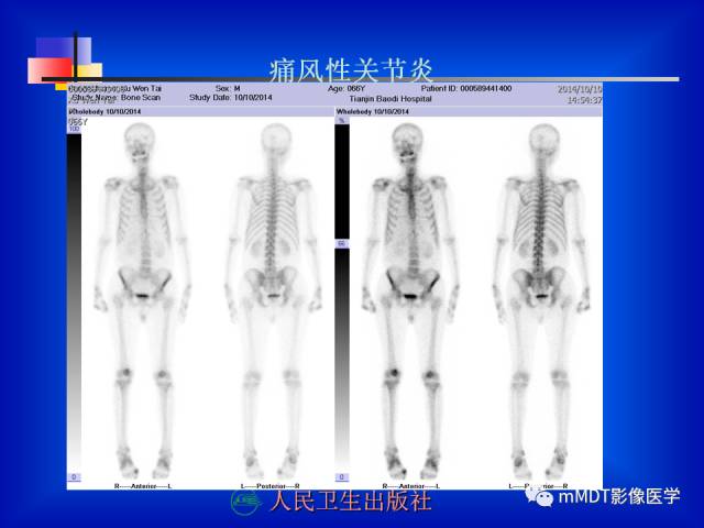 【PPT】骨骼系统核医学