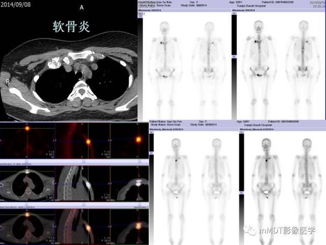 【PPT】骨骼系统核医学