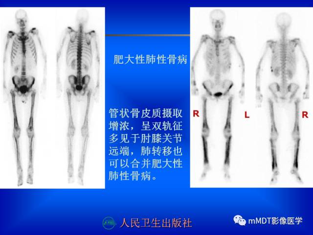【PPT】骨骼系统核医学