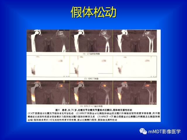 【PPT】骨骼系统核医学