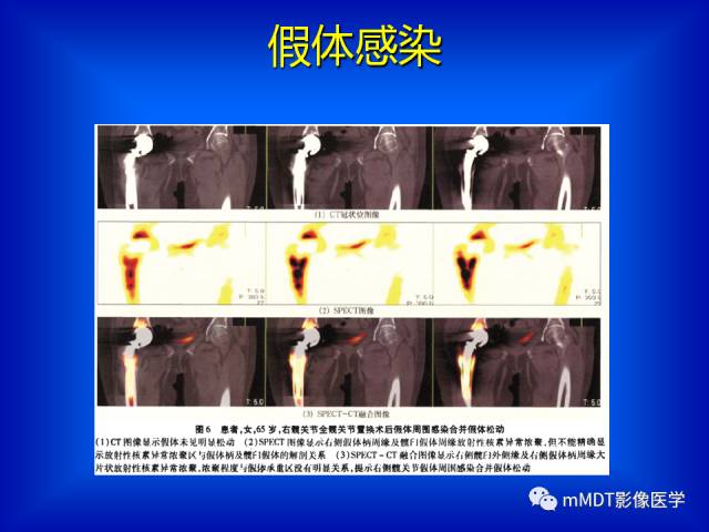 【PPT】骨骼系统核医学