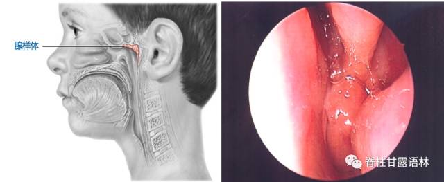 腺样体肥大 腺样体肥大