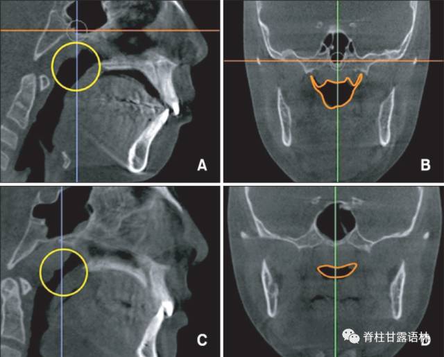 腺样体肥大 腺样体肥大