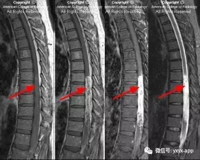 【病例】椎管神经鞘瘤1例MRI影像诊断分析