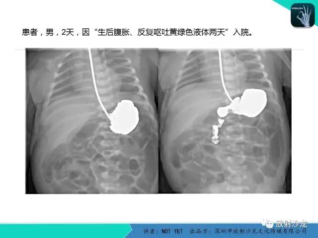 【病例】胃扭转1例X线影像表现