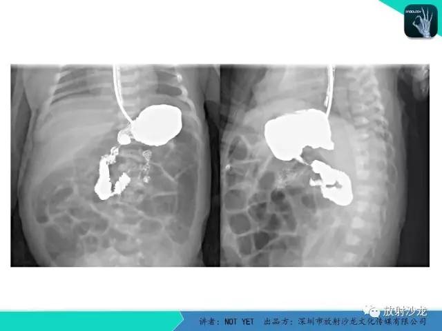 【病例】胃扭转1例X线影像表现
