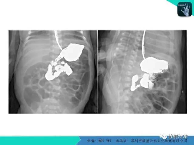 【病例】胃扭转1例X线影像表现