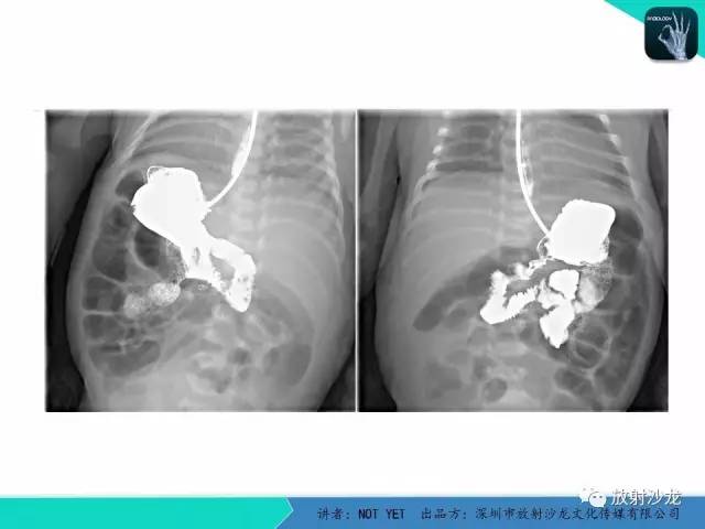 【病例】胃扭转1例X线影像表现