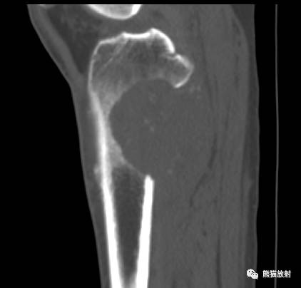 【病例】胫骨转移瘤1例X线CT及MR 【病例】胫骨转移瘤1例X线CT及MR