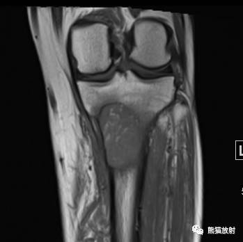 【病例】胫骨转移瘤1例X线CT及MR 【病例】胫骨转移瘤1例X线CT及MR