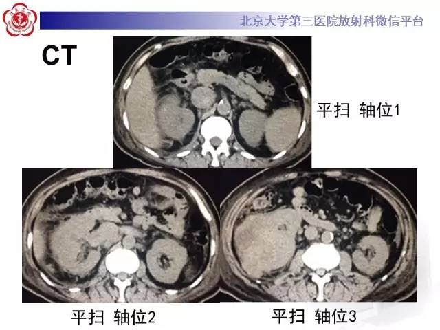 【病例】肾癌伴静脉癌栓形成1例CT及MR