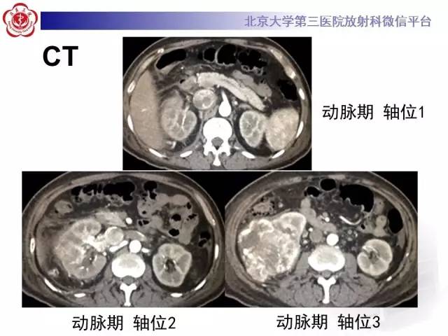 【病例】肾癌伴静脉癌栓形成1例CT及MR