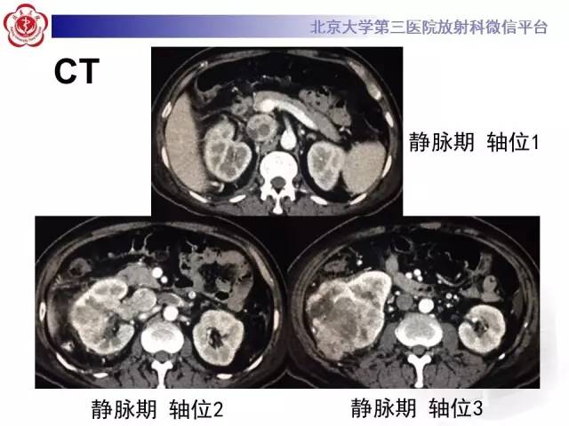 【病例】肾癌伴静脉癌栓形成1例CT及MR