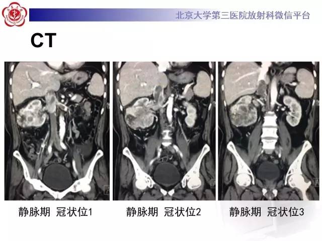 【病例】肾癌伴静脉癌栓形成1例CT及MR