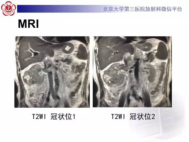 【病例】肾癌伴静脉癌栓形成1例CT及MR