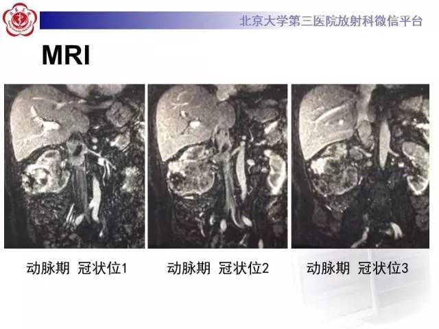 【病例】肾癌伴静脉癌栓形成1例CT及MR