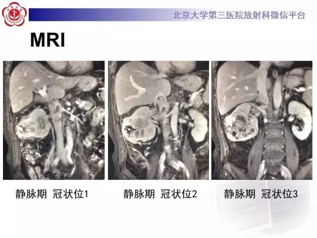 【病例】肾癌伴静脉癌栓形成1例CT及MR