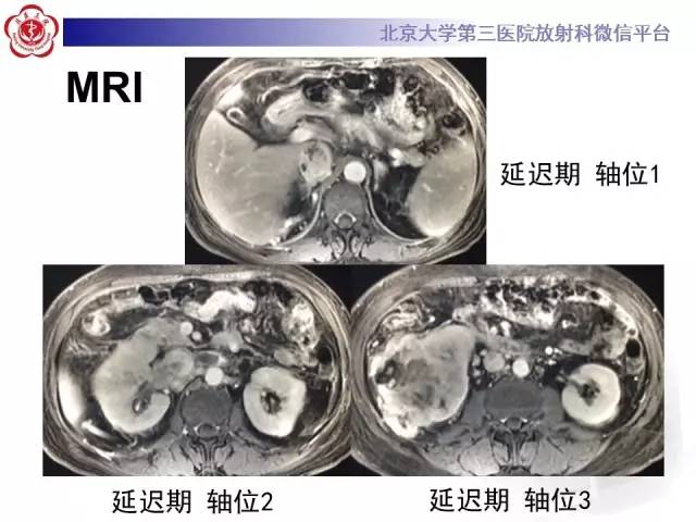 【病例】肾癌伴静脉癌栓形成1例CT及MR