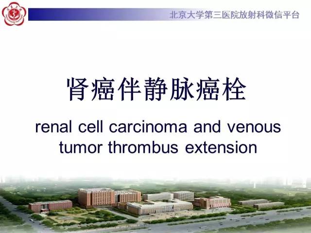 【病例】肾癌伴静脉癌栓形成1例CT及MR