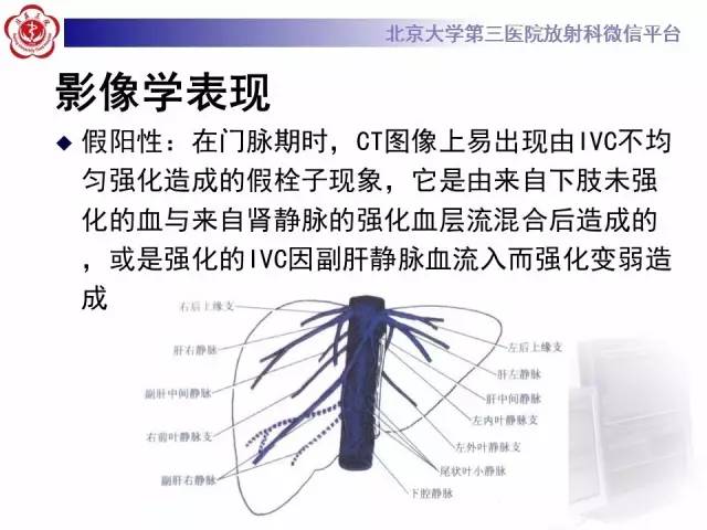 【病例】肾癌伴静脉癌栓形成1例CT及MR