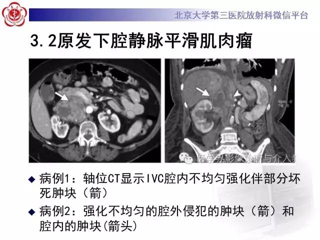 【病例】肾癌伴静脉癌栓形成1例CT及MR
