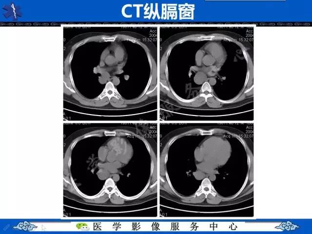 【病例】纵隔支气管囊肿1例CT影像表现