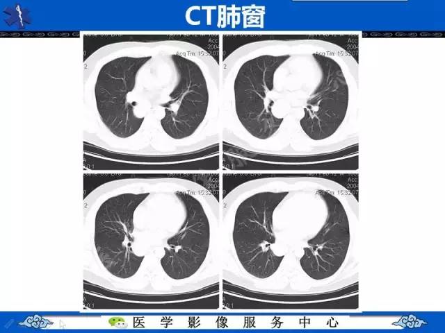 【病例】纵隔支气管囊肿1例CT影像表现