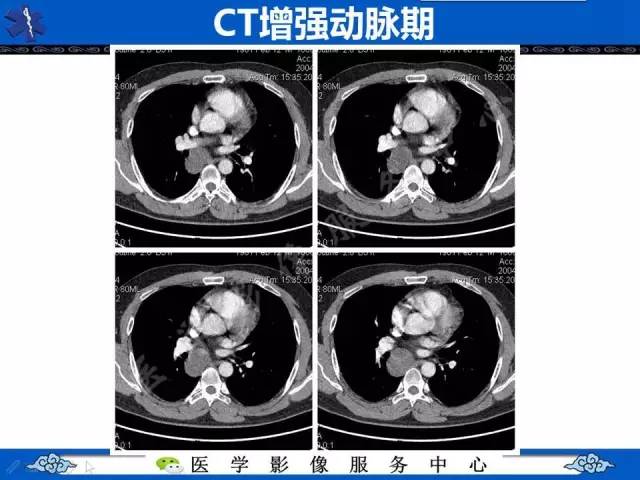 【病例】纵隔支气管囊肿1例CT影像表现