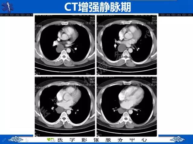 【病例】纵隔支气管囊肿1例CT影像表现