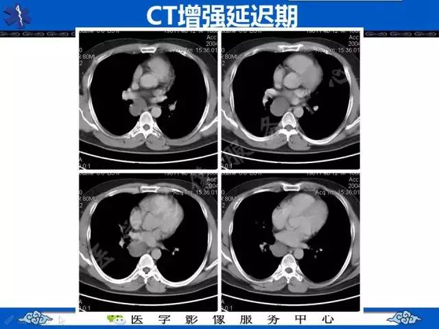 【病例】纵隔支气管囊肿1例CT影像表现