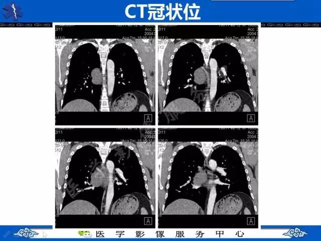 【病例】纵隔支气管囊肿1例CT影像表现