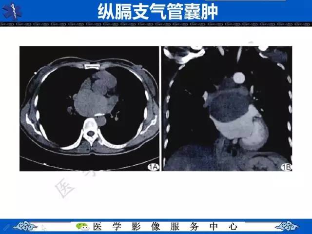 【病例】纵隔支气管囊肿1例CT影像表现