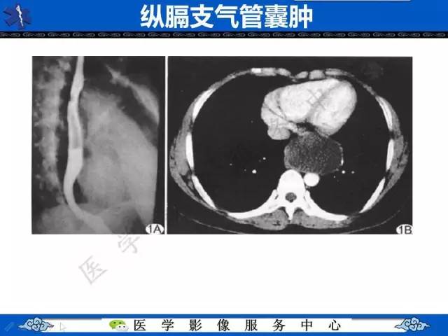 【病例】纵隔支气管囊肿1例CT影像表现