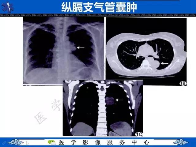 【病例】纵隔支气管囊肿1例CT影像表现