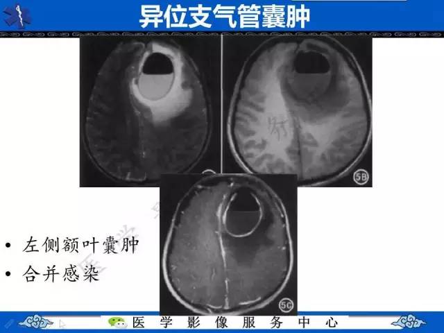 【病例】纵隔支气管囊肿1例CT影像表现