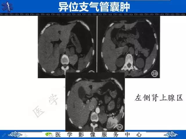 【病例】纵隔支气管囊肿1例CT影像表现