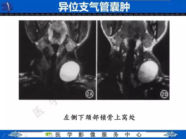 【病例】纵隔支气管囊肿1例CT影像表现