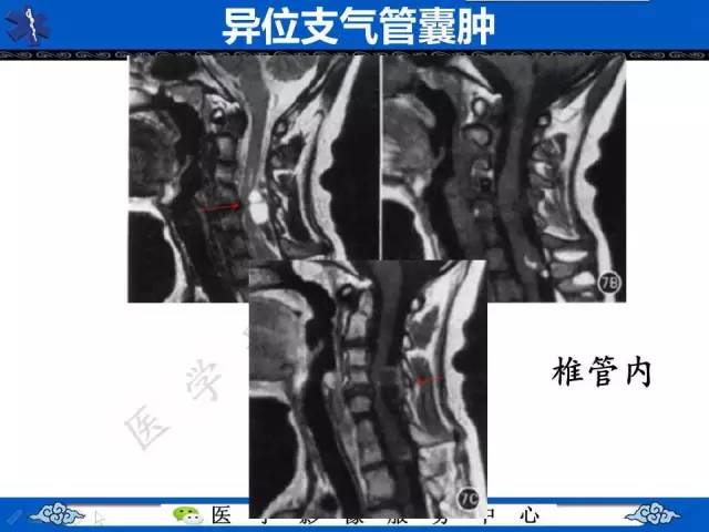 【病例】纵隔支气管囊肿1例CT影像表现