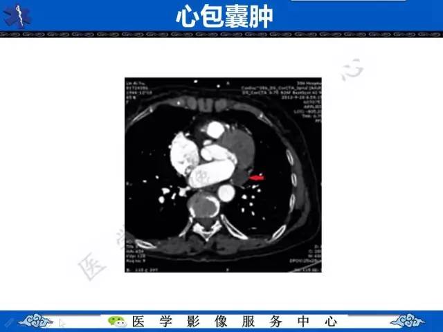 【病例】纵隔支气管囊肿1例CT影像表现