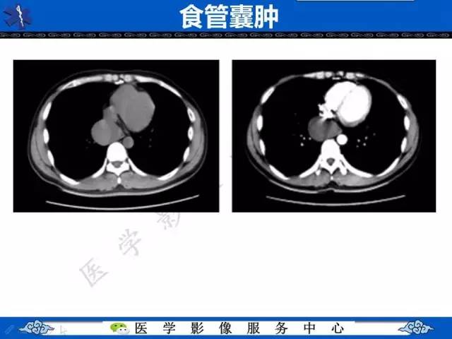 【病例】纵隔支气管囊肿1例CT影像表现