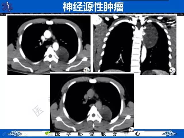 【病例】纵隔支气管囊肿1例CT影像表现