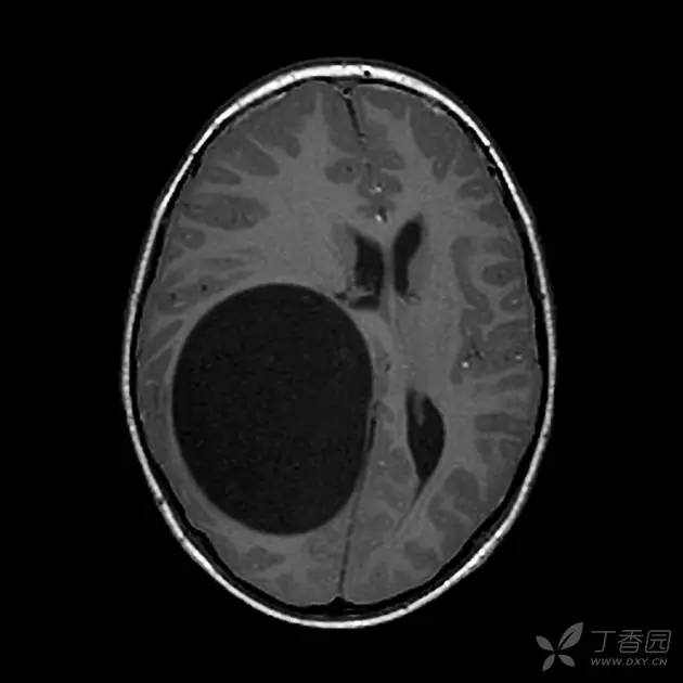 【病例】脑内囊性包虫病1例CT及MR 【病例】脑内囊性包虫病1例CT及MR
